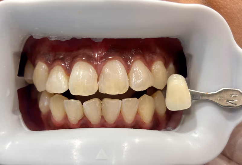 Glow Dental Bintulu teeth whitening patient smile transformation — after